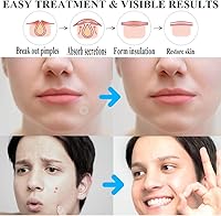 Zemolo Pickel Patch Hydrokolloid 300er-Pack — Bild 6