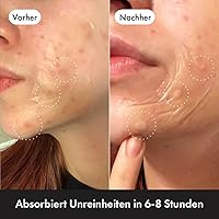 Hero Cosmetics Mighty Patch Surface (10 Stück) — Bild 3