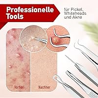 NEUMANN Mitesserentferner-Set NM-022 — Bild 4